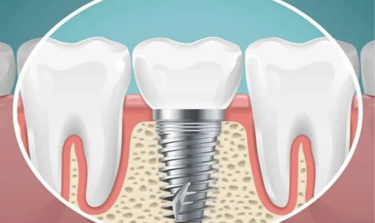 Konya Vidalı Diş Tedavisi ile Kalıcı Çözümler
