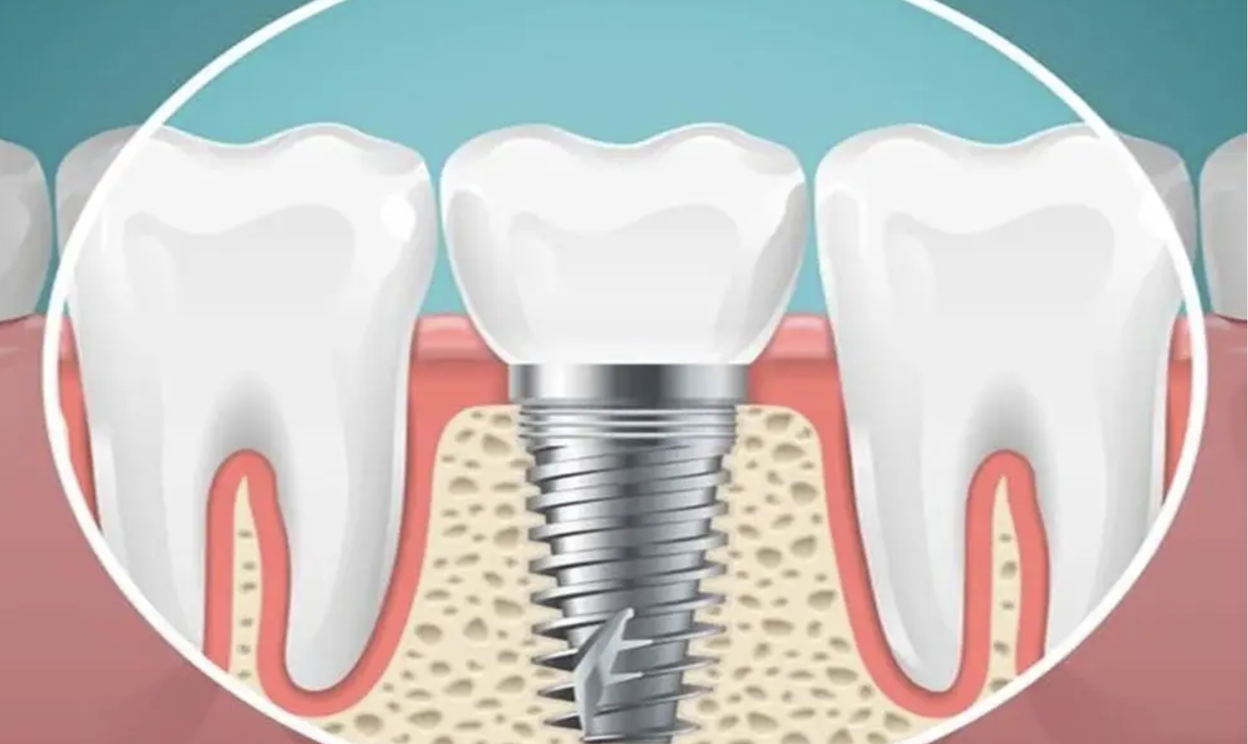 Konya Vidalı Diş Tedavisi ile Kalıcı Çözümler